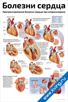 Плакат болезни сердца